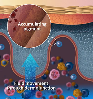 A diagramatic view of the accumulated pigment in the dermojunction